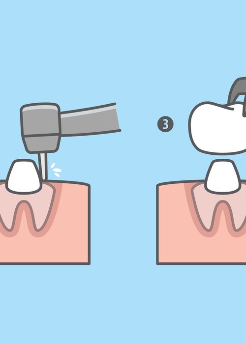 What is a Dental Crown