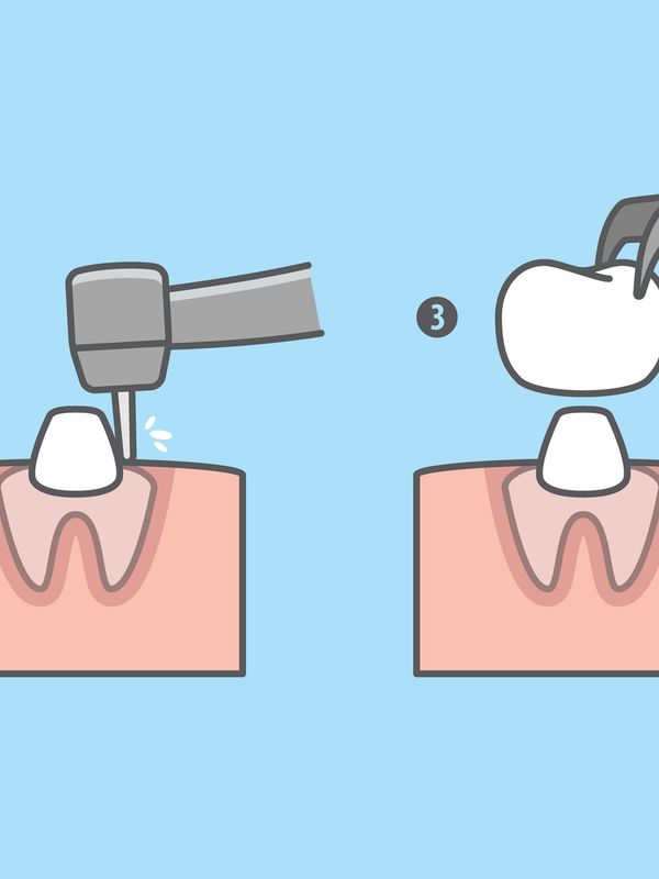 Dental Crown Process