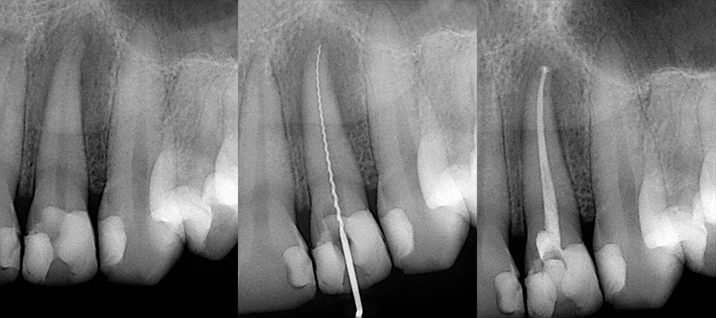 X-Ray Showing Tooth After Root Canal