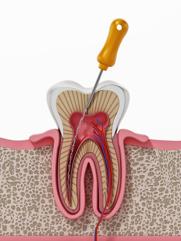 Root Canal Process