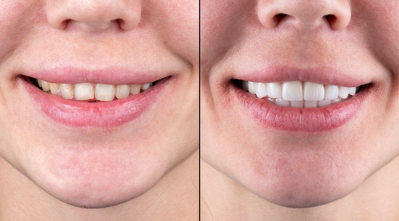 Smile Makeover Before After