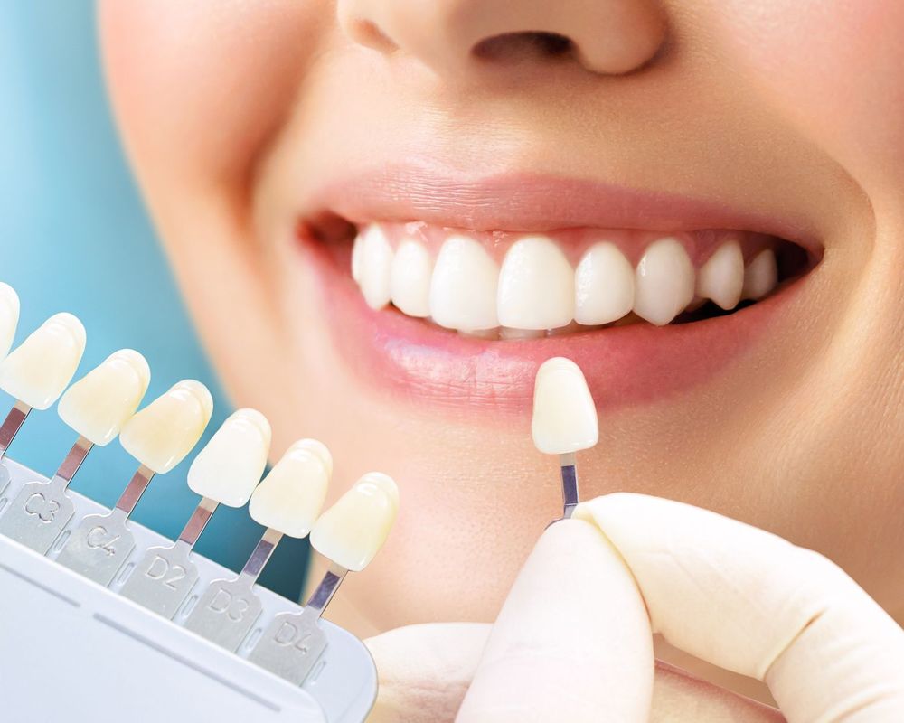 Smile Makeover Process - Matching Veneers Colors with Natural Teeth