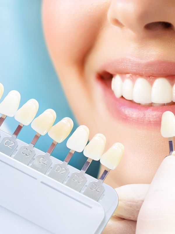 Smile Makeover Process - Matching Veneers Colors with Natural Teeth