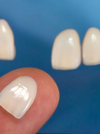 Veneers Benefits