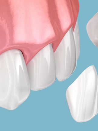 Veneers Process