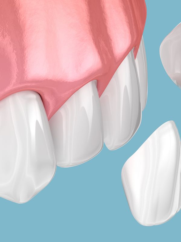 Veneers Process
